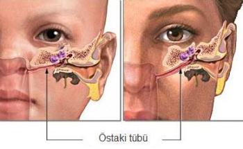 Östaki Borusu Disfonksiyonu